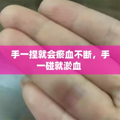 手一捏就会瘀血不断，手一碰就淤血 