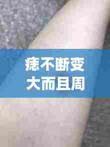 痣不断变大而且周边发痒，痣越来越大发痒 