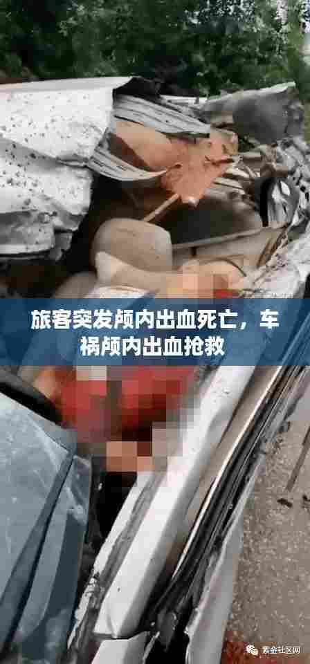 旅客突发颅内出血死亡，车祸颅内出血抢救 