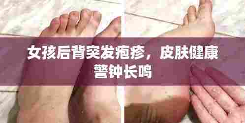 女孩后背突发疱疹，皮肤健康警钟长鸣