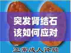 突发肾结石该如何应对？有效处理肾结石突发状况的方法！