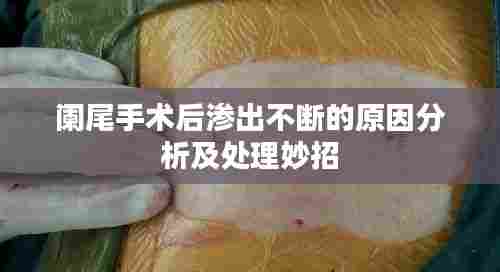 阑尾手术后渗出不断的原因分析及处理妙招